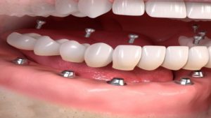 كم تستغرق زراعة الاسنان الفورية